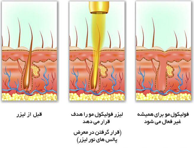 ویژگی دستگاه لیزر رفع مو